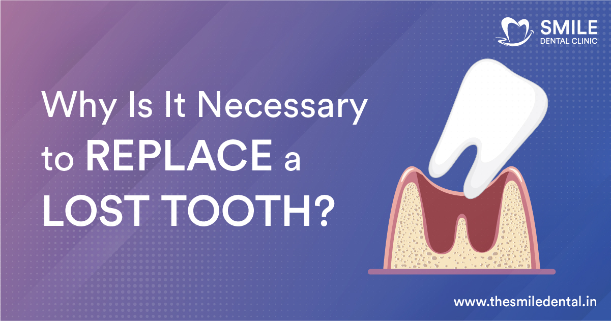Why Is It Necessary to Replace a Lost Tooth?