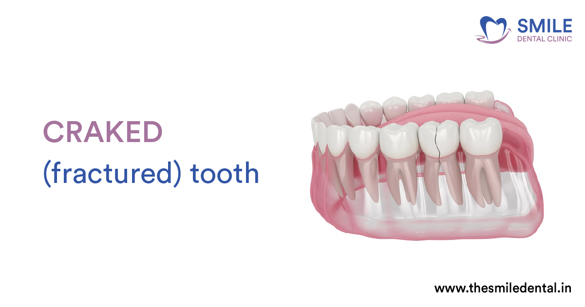 What Is a Fractured Tooth? How Can It Be Treated?