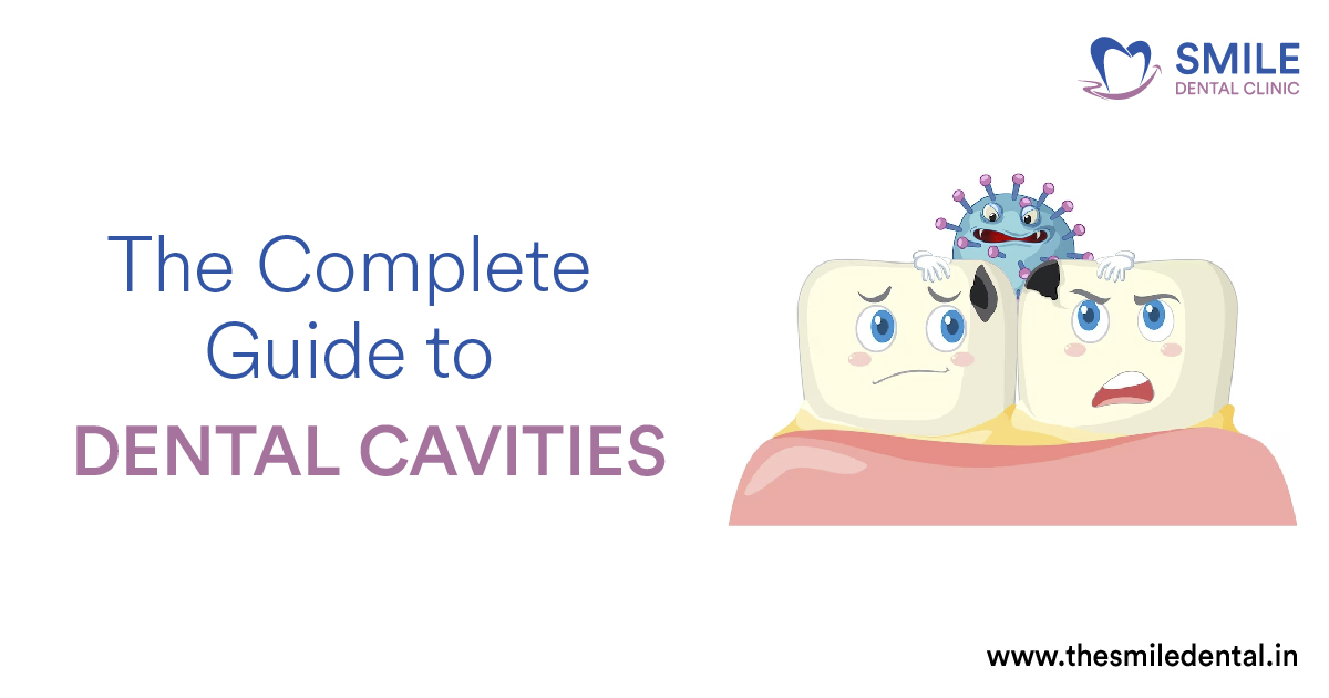 The Complete Guide to Dental Cavities: Causes, Symptoms, and Treatment