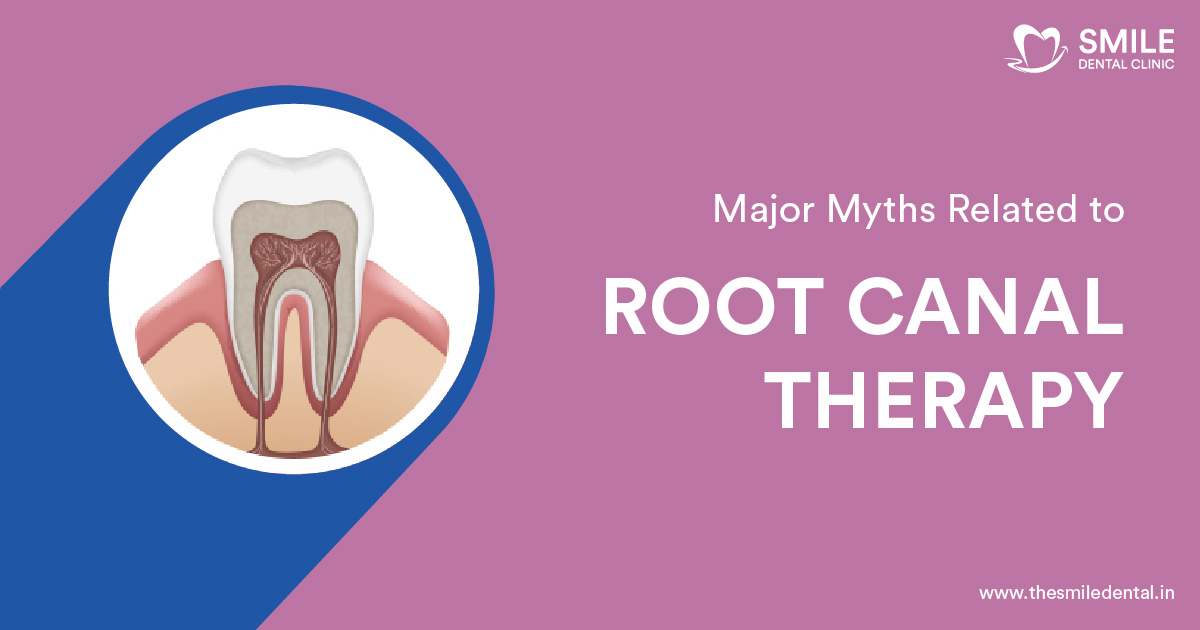 Top 5 Myths about Root Canal Treatment Debunked