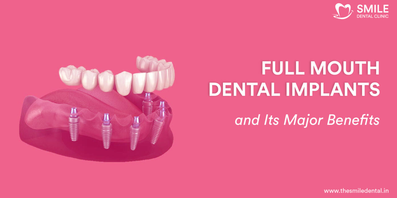 Full Mouth Dental Implants in Ranip: A Detailed Guide to Smile Restoration and Its Advantages