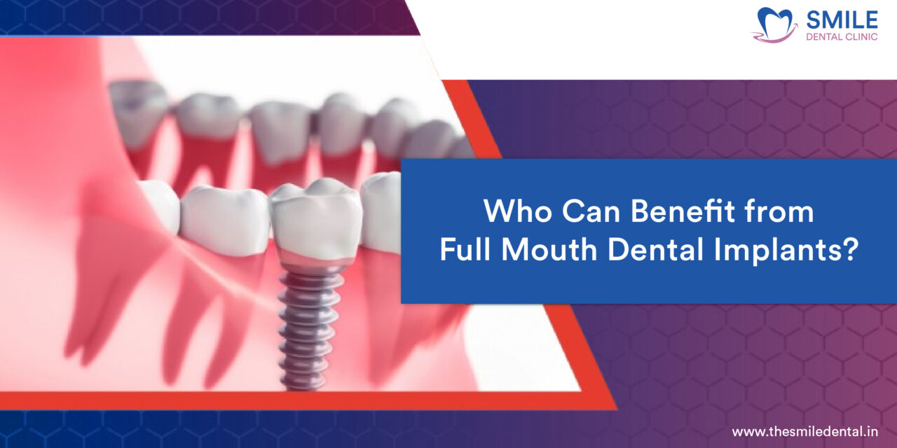 Full Mouth Dental Implants: Who Can Benefit from It?